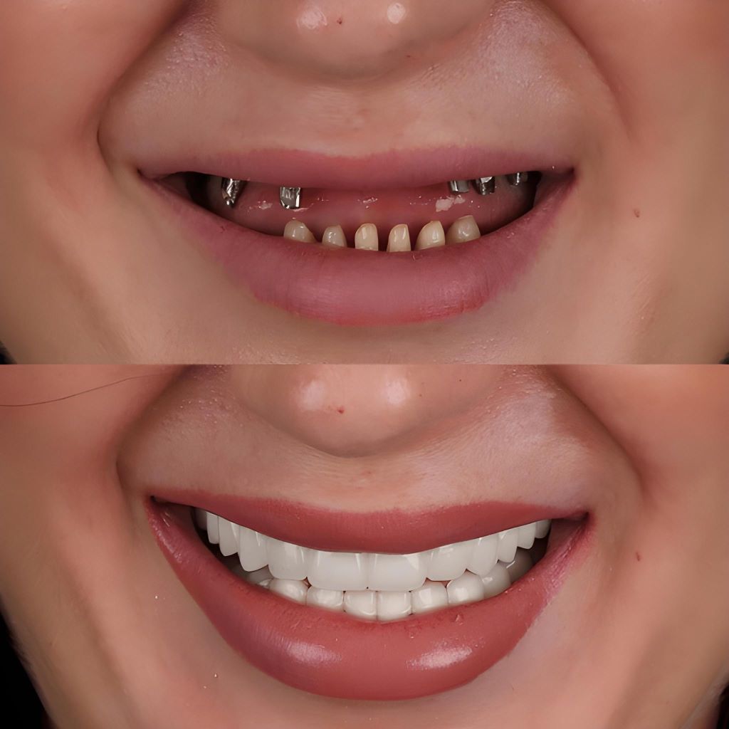 all on 4 implants in palm harbor, fl