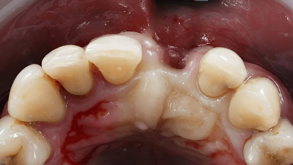 bone grafting near you