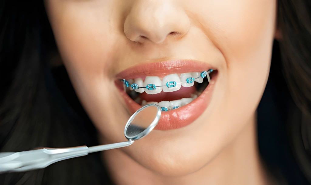 dental braces in palm harbor, fl