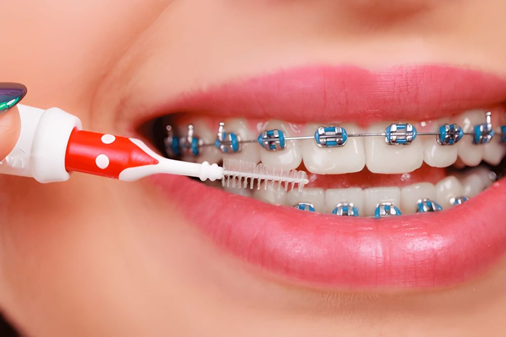 dental braces near you