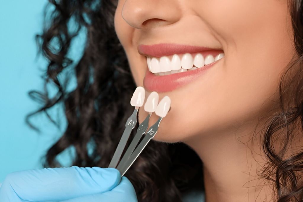 dental veneers in palm harbor, fl