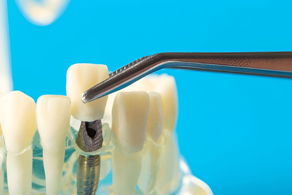 metal free crowns near you