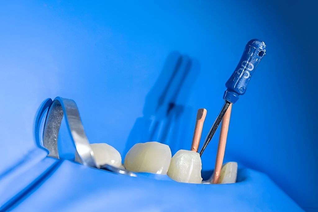 root canal therapy near you