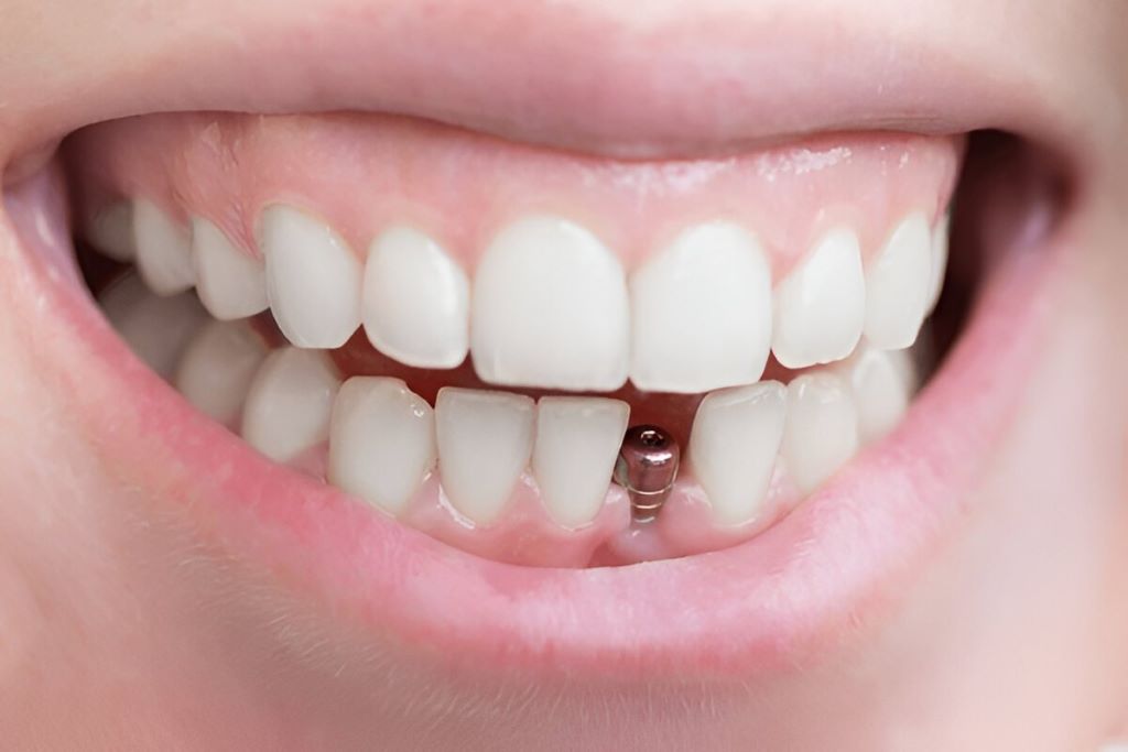 single tooth implant near you