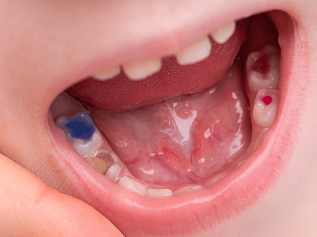 tooth colored fillings near you