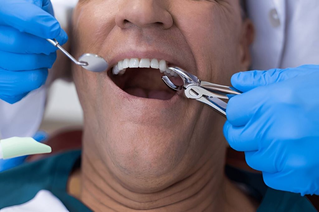 tooth extractions in palm harbor, fl